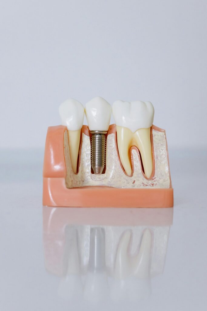 SolSmile Lounge | Dental Implants vs. Dentures: Which Tooth Replacement Option Is Right for You? SolSmile Lounge | Dental Implants vs. Dentures: Which Tooth Replacement Option Is Right for You?