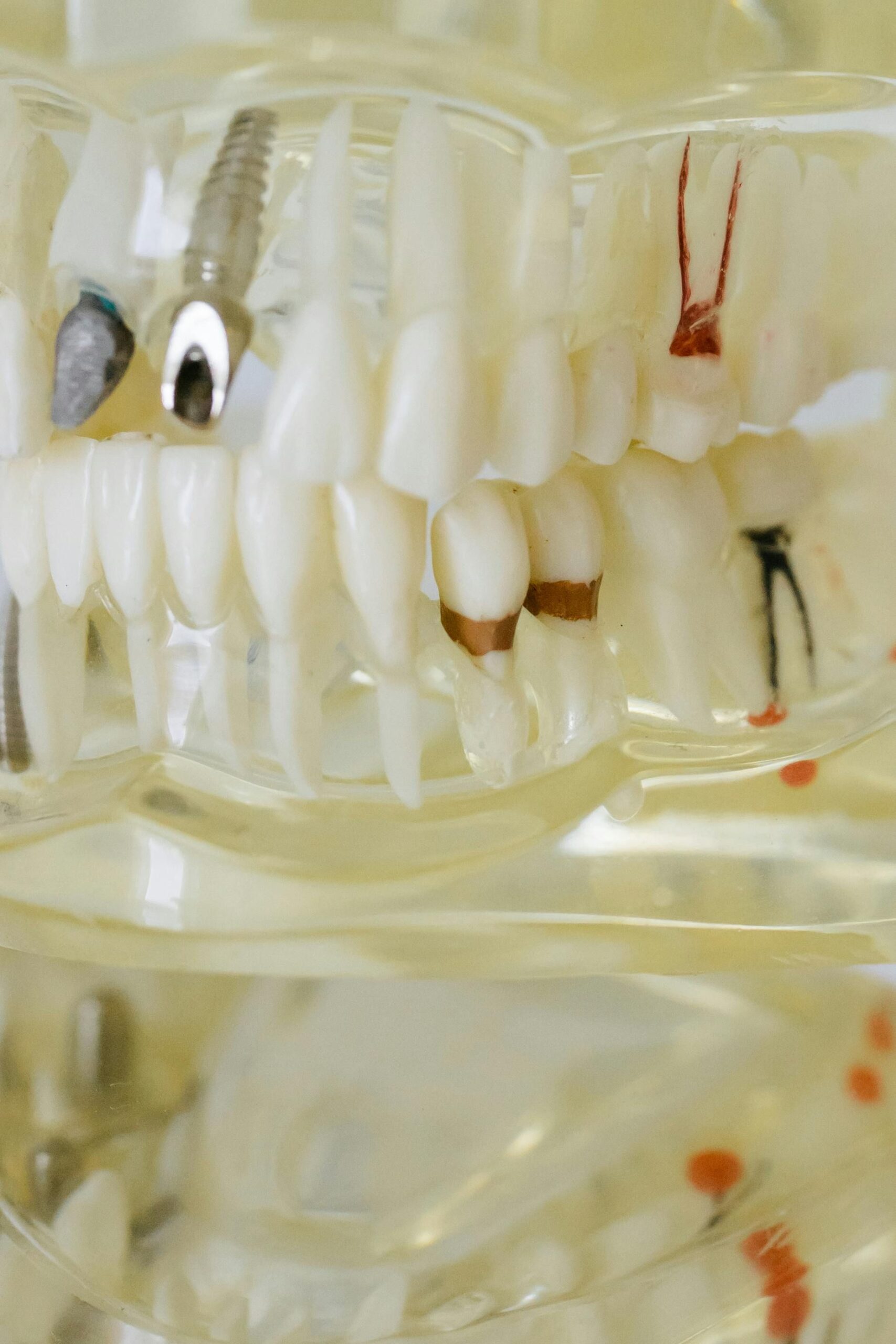 SolSmile Lounge | From Missing Tooth to Million-Dollar Smile: The Transformative Power of Dental Implants