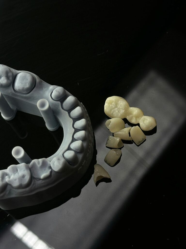SolSmile Lounge | Dental Implants: The Best Long-Term Solution for Missing Teeth